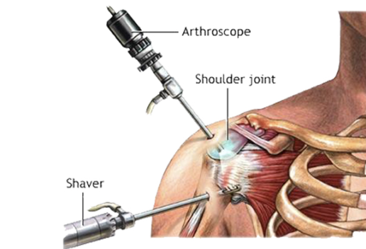 Keyhole Surgery Laparoscopy