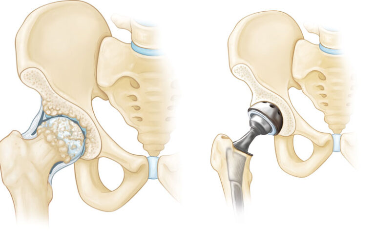 detailed hip replacement surgery