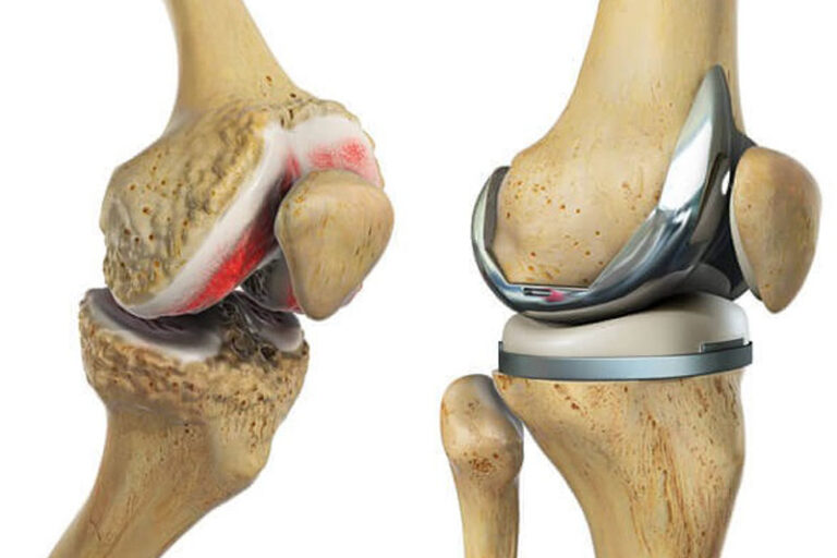 Knee Replacement Surgery Canada